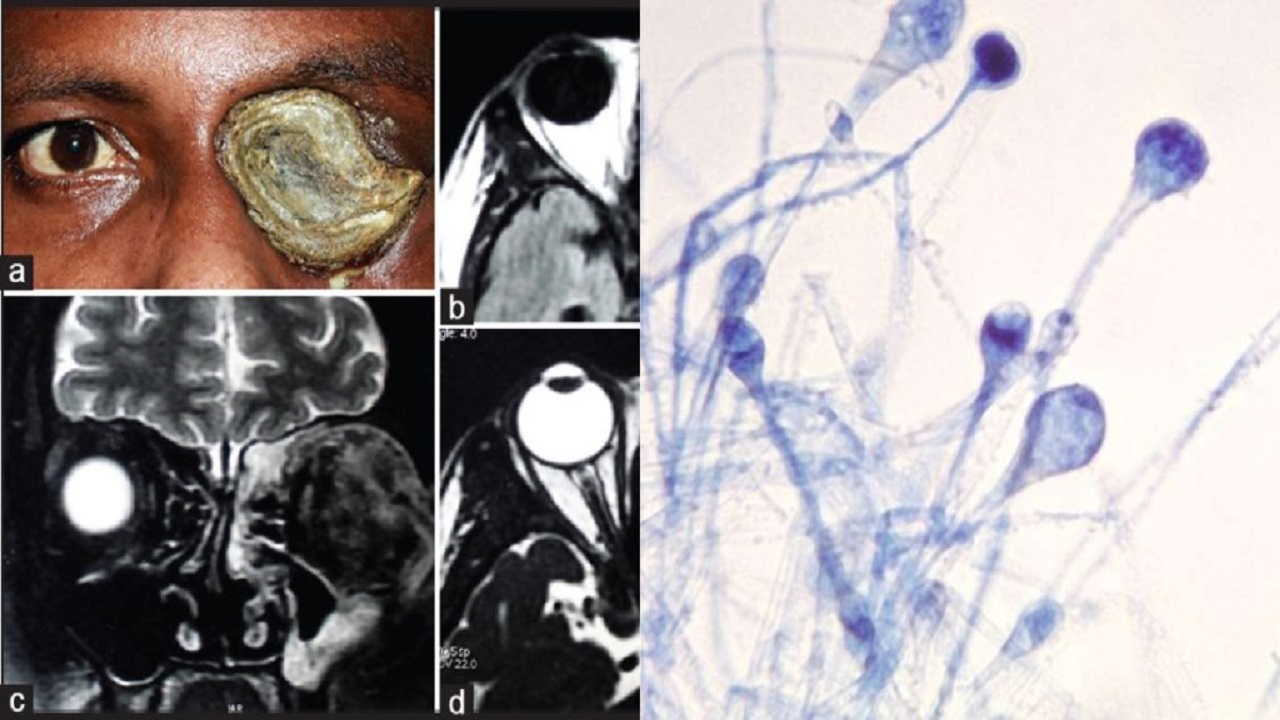 mucormycosis