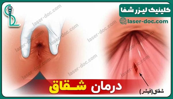 شقاق یا فیشر