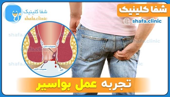 عمل لیزر بواسیر