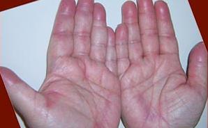 the-hand-foot-syndrome.jpg