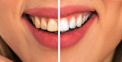 natural-tooth-decay1-3.jpg