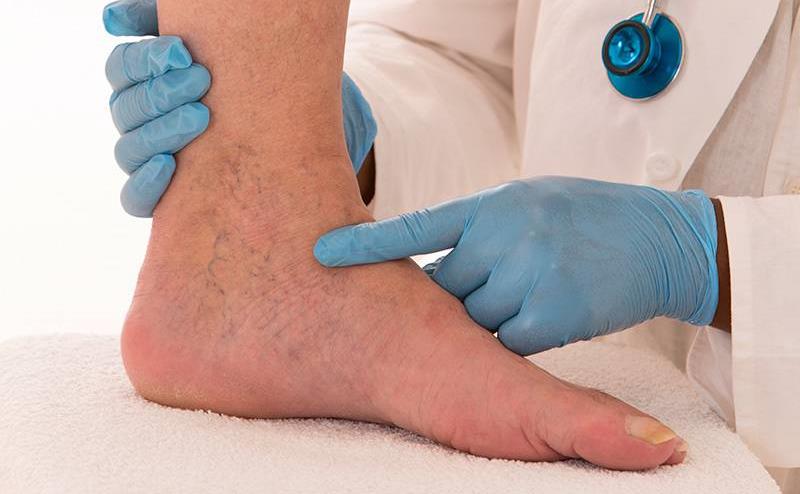 is_160912_varicose_veins_800x600.jpg