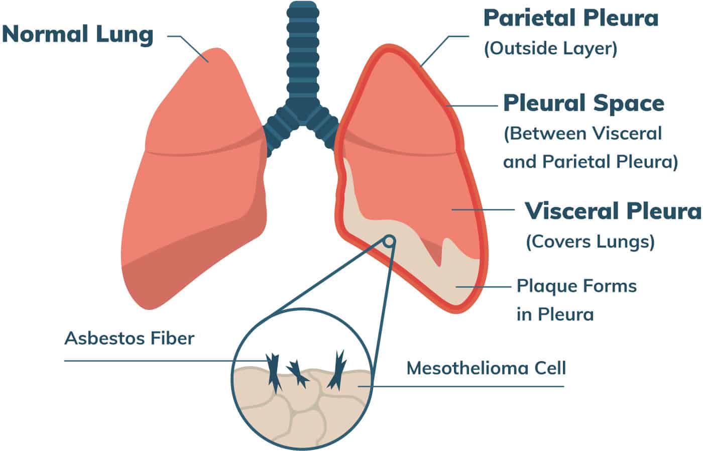 Mesothelioma.com_how_mesothelioma_forms.jpg