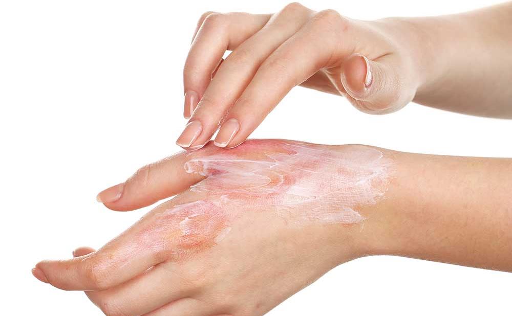 Fast-burn-treatment-decreases-mortality.jpg