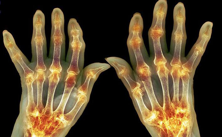Arthritis-Symptoms.jpg