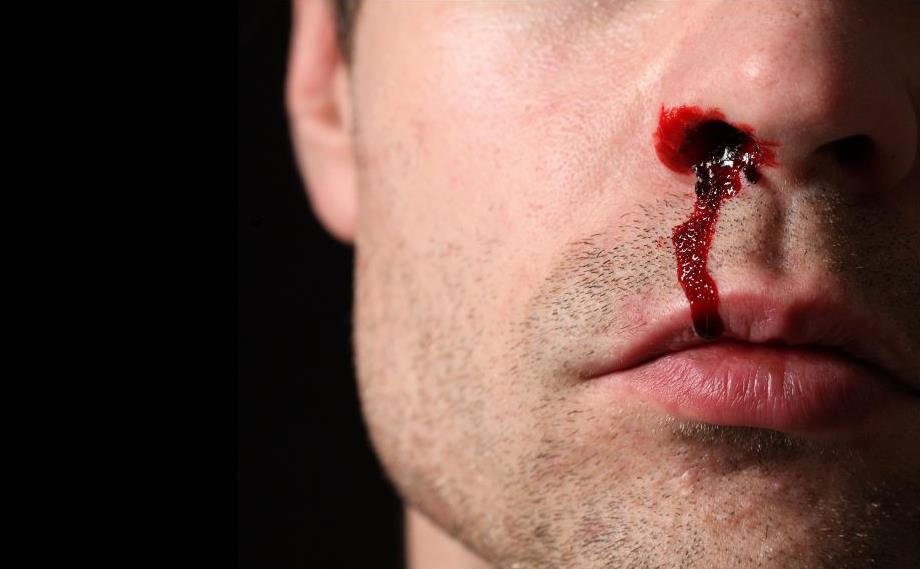 When-Is-a-Bloody-Nose-an-EmergencY-1024x683.jpg