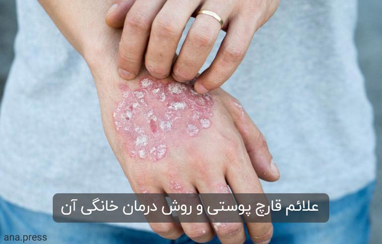 قارچ-پوستی-1.jpg