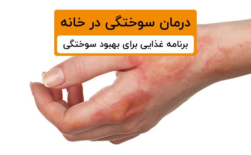 سوختگی-1.jpg