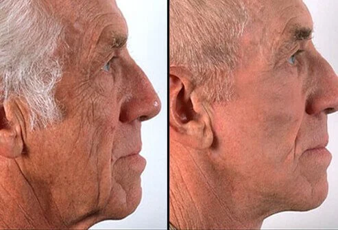 Screenshot_2020-12-01 cosmetic_surgery_before_after_s5_facelift webp (WEBP Image, 493 × 335 pixels).png
