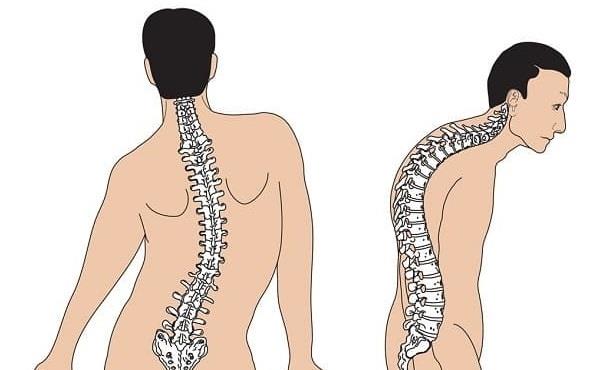 Scoliosis1-min.jpg