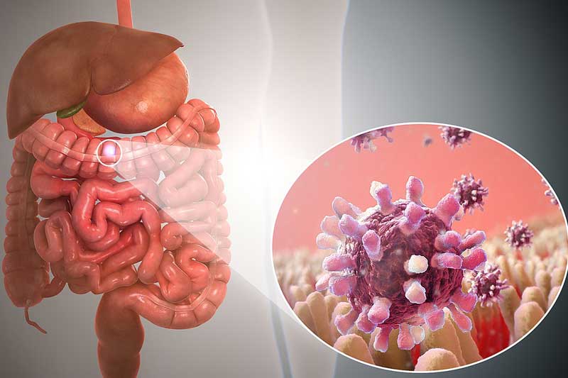 1280px-Gastroenteritis.jpg