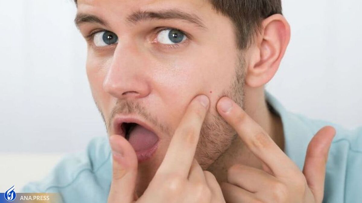 مصرف زیاد شیر برای افراد مبتلا به آکنه پوستی مضر است