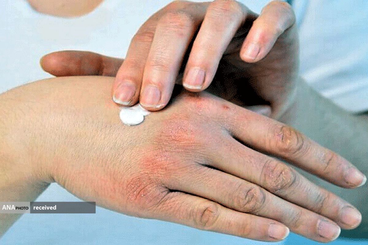 لزوم استفاده از کرمهای آبرسان برای مقابله با خشکی پوست