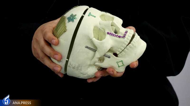 درمان هزار بیمار با اختراع فک مصنوعی