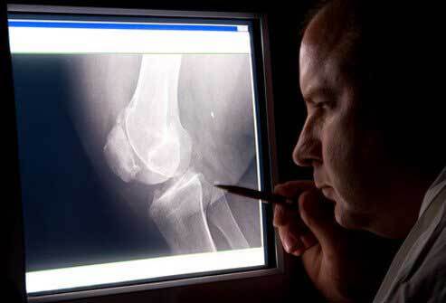 فناوریهای جدید برای مبارزه با پوکی استخوان/ استفاده از سلولهای بنیادی تا تولید چارچوب پلیمری فناوریهای جدید برای مبارزه با پوکی استخوان/ استفاده از سلولهای بنیادی تا تولید چارچوب پلیمری