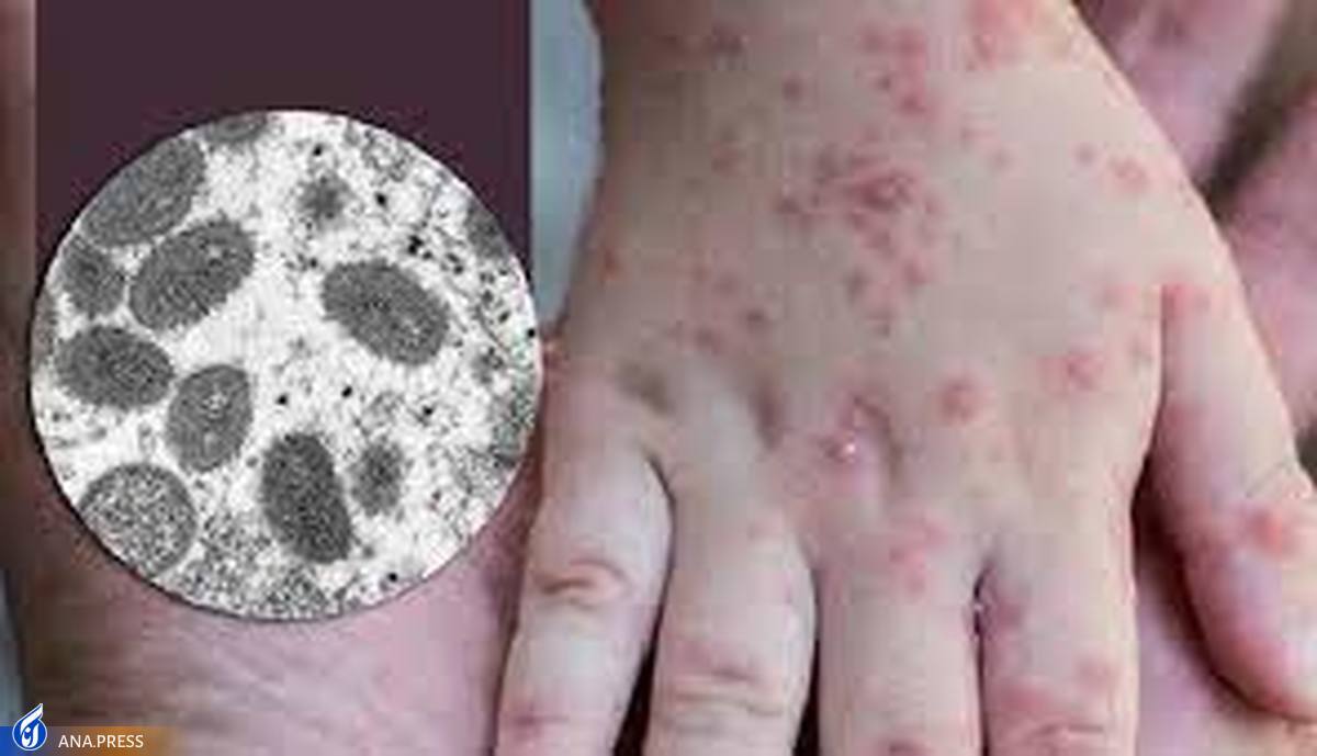 ضرورت افزایش تزریق واکسن برای توقف شیوع آبله میمون