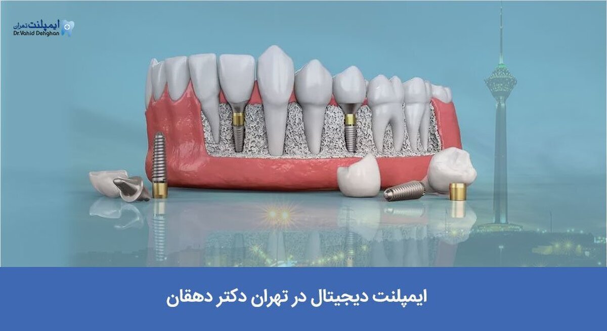 ایمپلنت دیجیتال در تهران دکتر دهقان