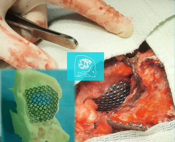 ساخت نمونه سهبعدی فیزیکی ضایع بیمار برای جراحی ترمیمی ساخت نمونه سهبعدی فیزیکی ضایع بیمار برای جراحی ترمیمی