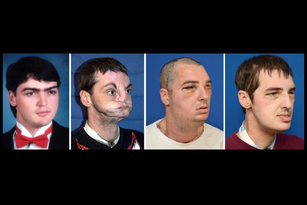 آینده پیوند صورت؛ از فیلم تعویض چهره تا پوشیدن پوست! آینده پیوند صورت؛ از فیلم تعویض چهره تا پوشیدن پوست!