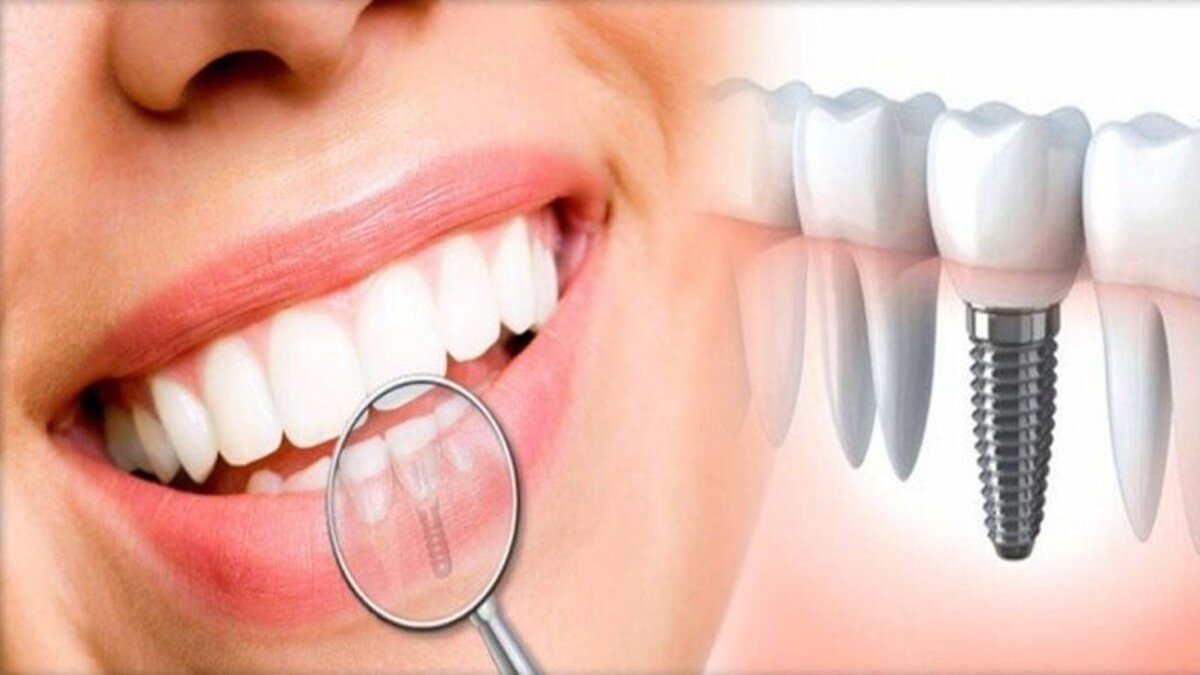 ایمپلنت اقساطی دندان برای کاهش هزینه‌ها