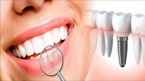 ایمپلنت اقساطی دندان برای کاهش هزینه‌ها