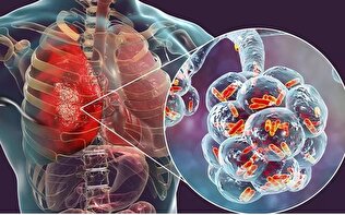 ساخت دستگاه کمک‌سرفه برای بیماران تنفسی با قابلیت نابودی ترشحات سینه و ریه‌