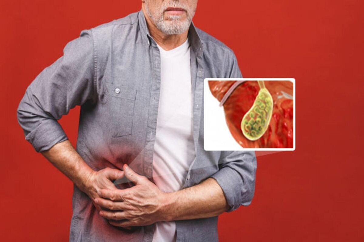 سنگ کیسه صفرا چیست و چگونه درمان میشود؟
