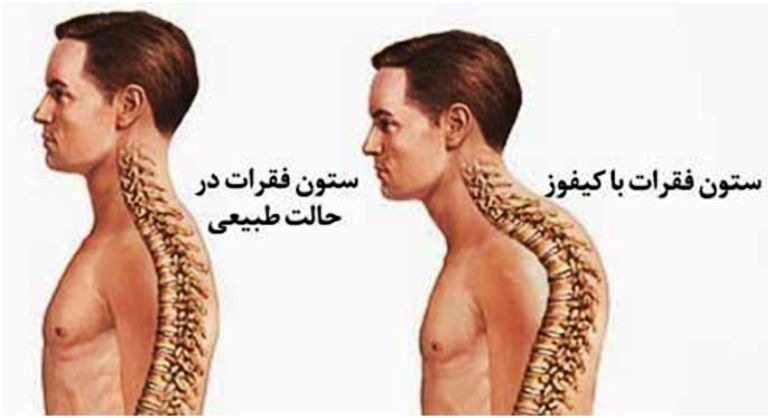 ناهنجاری کیفوز (گردپشتی- گوژپشتی- قوزپشتی) ناهنجاری کیفوز (گردپشتی- گوژپشتی- قوزپشتی)