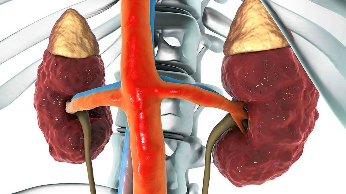 فعالیت موثر مرکز تحقیقات بیماریهای کلیه در درمان سرطانهای دستگاه ادراری