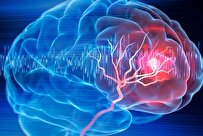 شانس زنده ماندن بعد از سکته مغزی پولدارها بیشتر از سایرین است