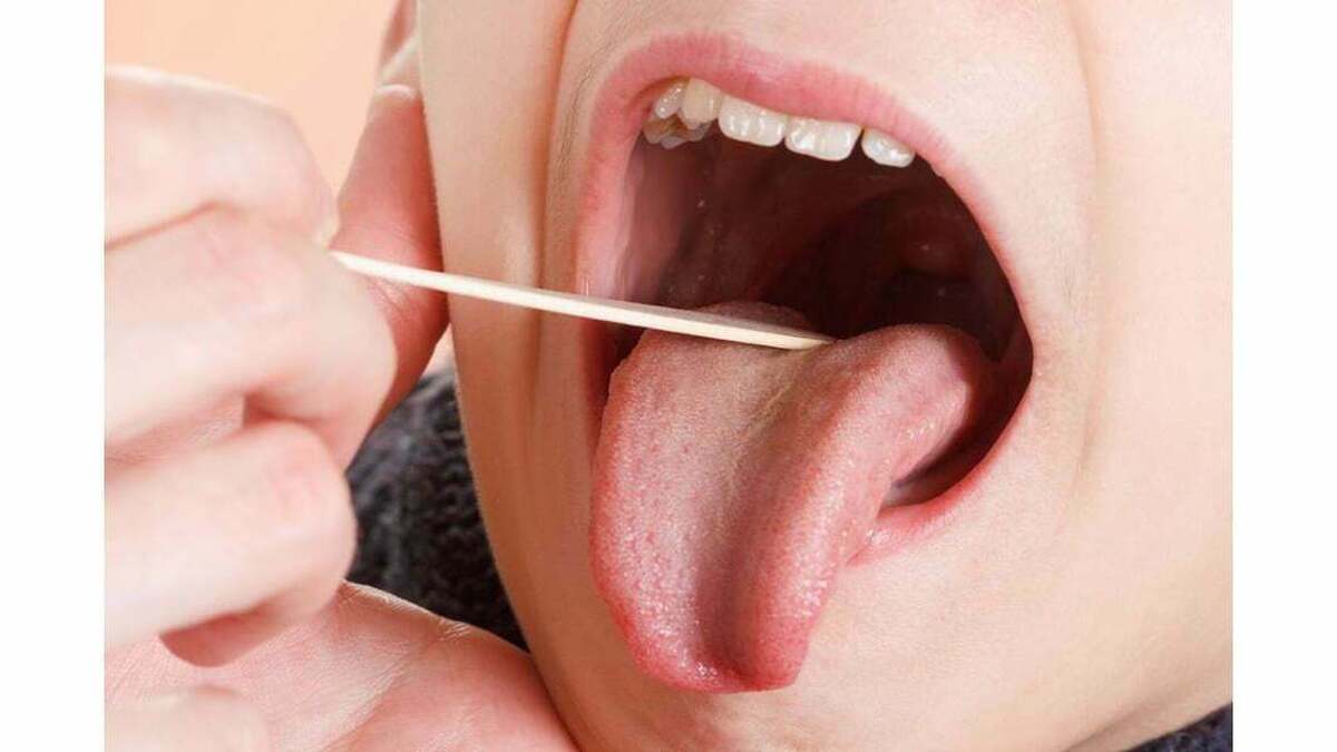 پوسیدگی و عفونت دندان، شایعترین علل سرطان دهان