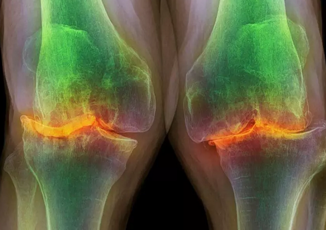 آیا مشکلات اسکلتی عضلانی به سراغ جوانان هم میرود؟ آیا مشکلات اسکلتی عضلانی به سراغ جوانان هم میرود؟