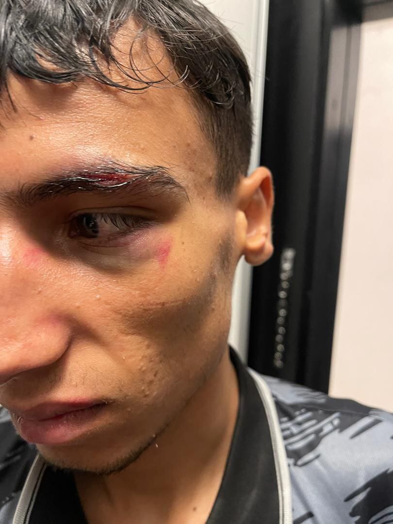 آسیب&zwnj;دیدگی شدید کاظمی از ناحیه ابرو&zwnj; و بینی توسط حرکت غیرورزشی بوکسور افغانستان +عکس