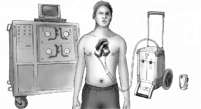 ۱۱ حقیقت درباره «قلب مصنوعی»/ اولین پیوند قلب مصنوعی دائمی در 1982 صورت گرفت! ۱۱ حقیقت درباره «قلب مصنوعی»/ اولین پیوند قلب مصنوعی دائمی در 1982 صورت گرفت!