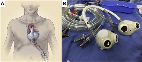 ۱۱ حقیقت درباره «قلب مصنوعی»/ اولین پیوند قلب مصنوعی دائمی در 1982 صورت گرفت! ۱۱ حقیقت درباره «قلب مصنوعی»/ اولین پیوند قلب مصنوعی دائمی در 1982 صورت گرفت!