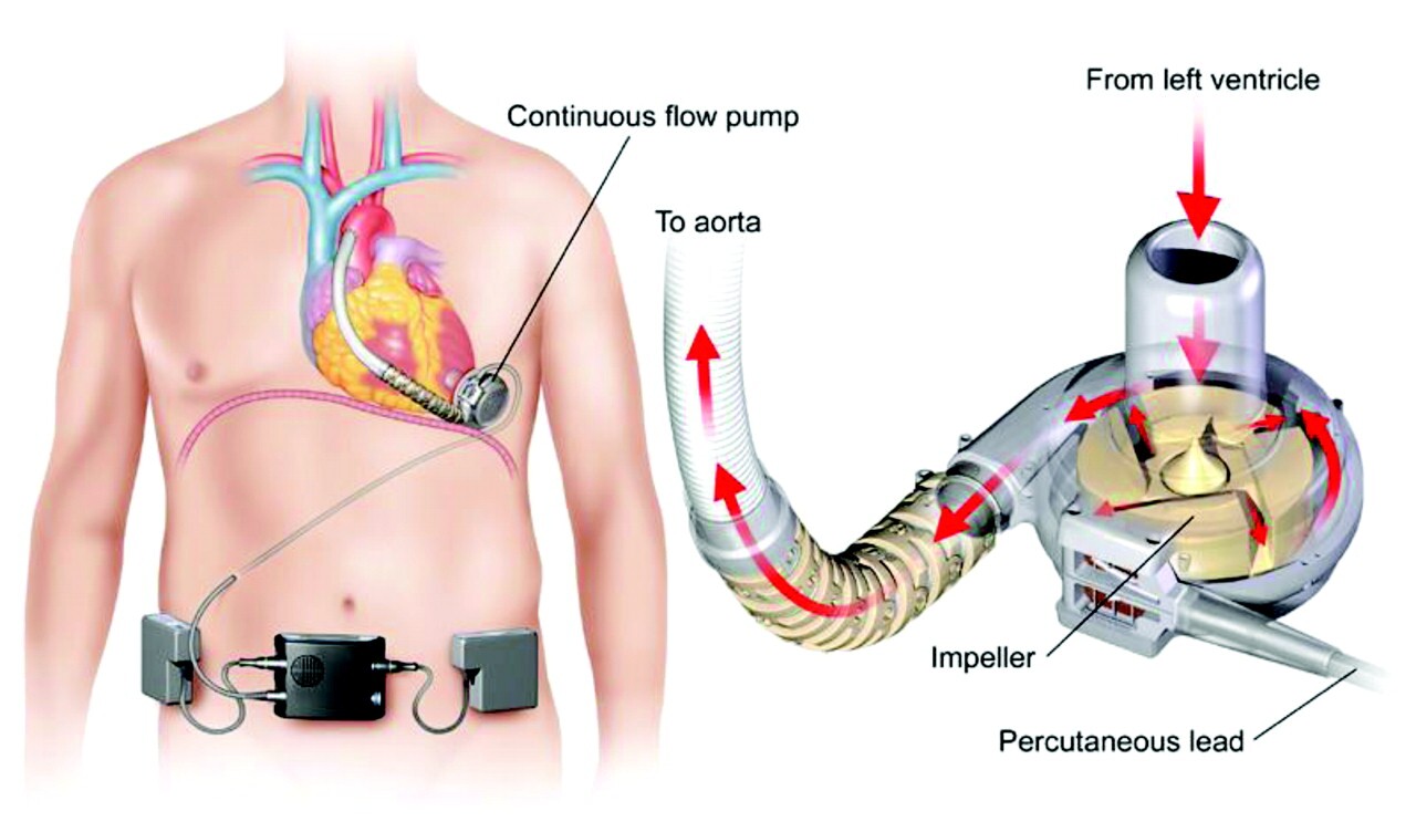 ۱۱ حقیقت درباره «قلب مصنوعی»/ اولین پیوند قلب مصنوعی دائمی در 1982 صورت گرفت! ۱۱ حقیقت درباره «قلب مصنوعی»/ اولین پیوند قلب مصنوعی دائمی در 1982 صورت گرفت!