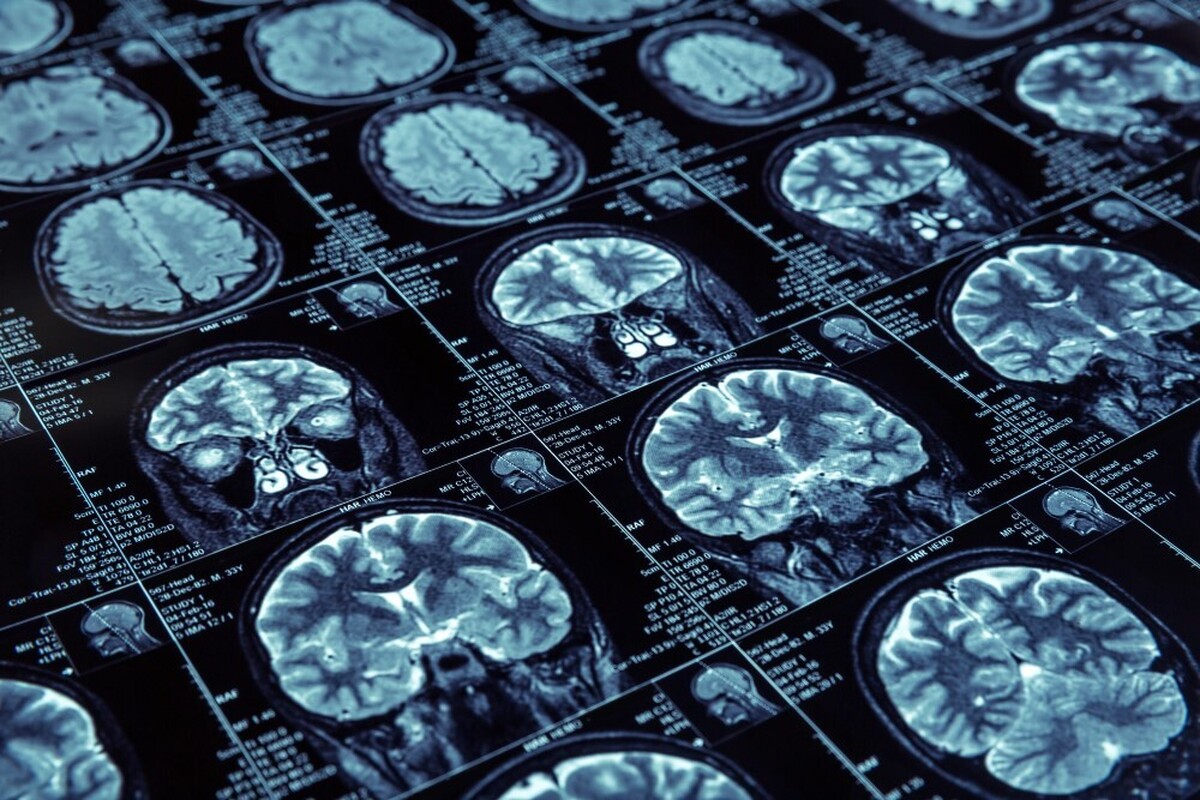 تشخیص موارد نرمال و غیرنرمال تومور از تصاویر MRI ممکن می شود