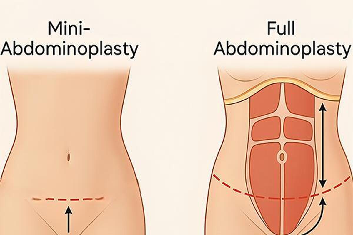 تفاوت ابدومینوپلاستی با مینی ابدوپلاستی چیست؟