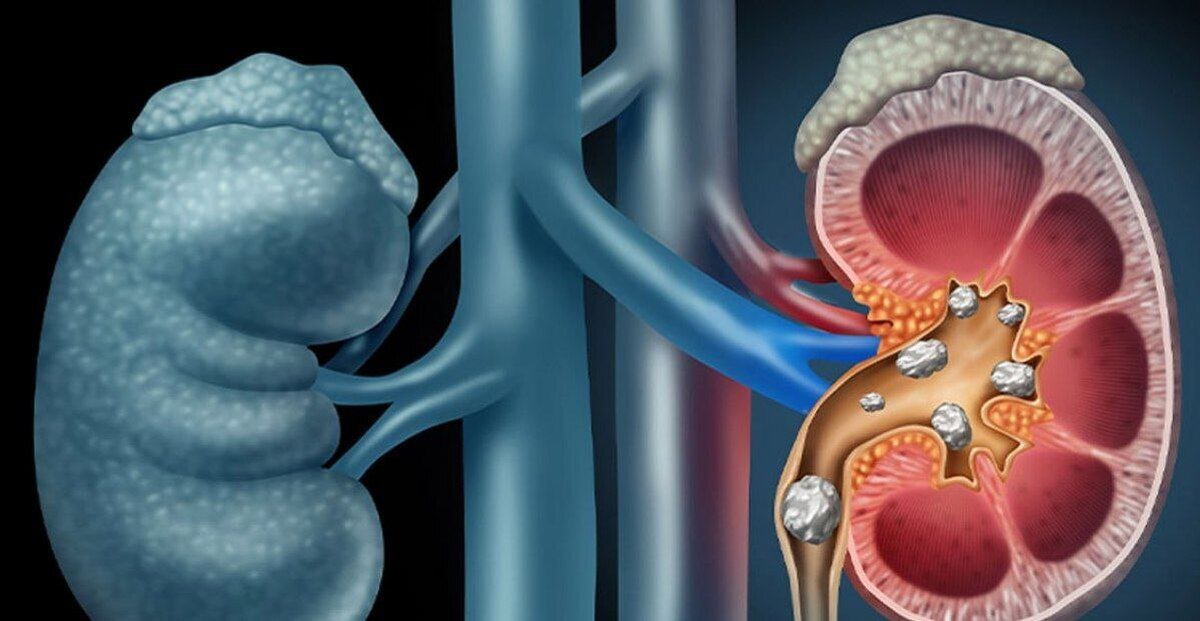علائم، درمان و باورهای غلط درباره سنگ کلیه