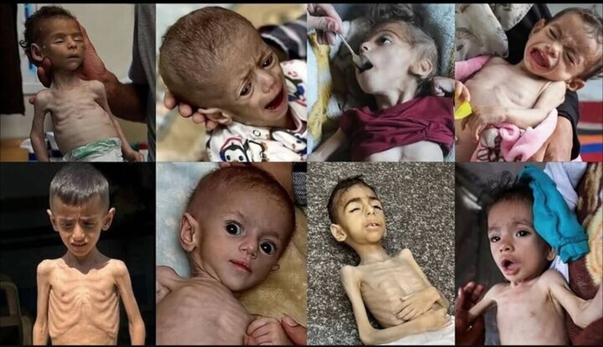 ۲۱۷ نفر در غزه بر اثر گرسنگی و سوءتغذیه شهید شدند