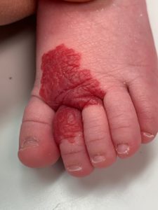 ماه گرفتگی پوستی؛ ردی که ژنها بر تن میگذارند ماه گرفتگی پوستی؛ ردی که ژنها بر تن میگذارند