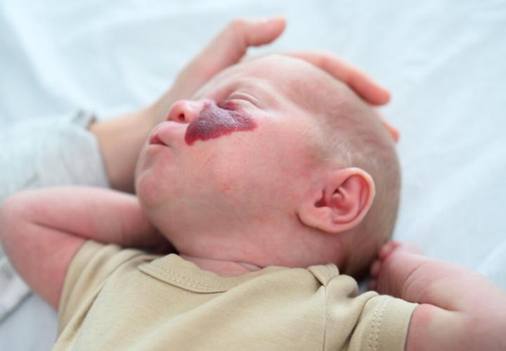 ماه گرفتگی پوستی؛ ردی که ژنها بر تن میگذارند ماه گرفتگی پوستی؛ ردی که ژنها بر تن میگذارند