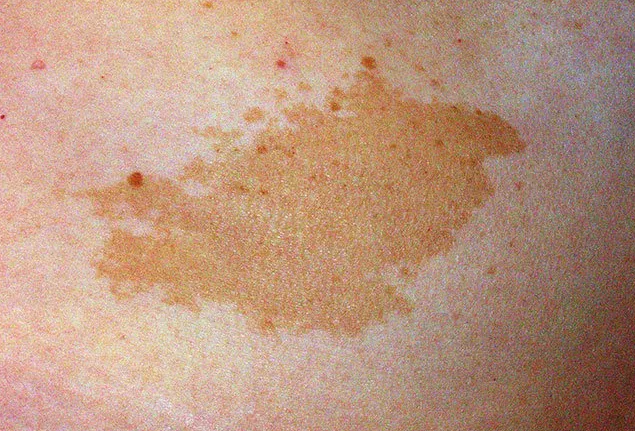 ماه گرفتگی پوستی؛ ردی که ژنها بر تن میگذارند ماه گرفتگی پوستی؛ ردی که ژنها بر تن میگذارند