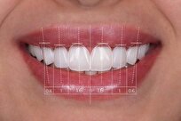 ۶۰٪ استحکام بیشتر دندان با انتخاب این کامپوزیت‌ها