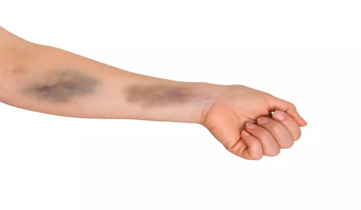 کبودی&zwnj;های مرموز دست ترامپ و ملکه؛ علل پشت پرده این آسیب&zwnj;های پوستی