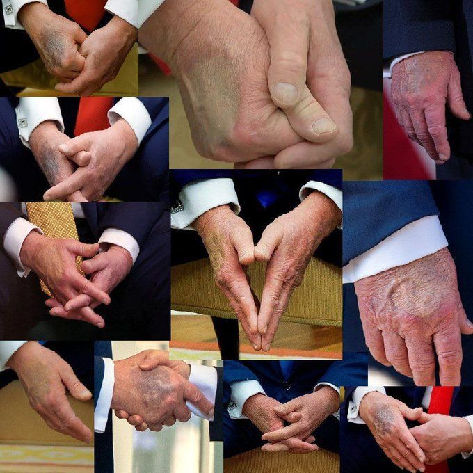 کبودی&zwnj;های مرموز دست ترامپ؛ علل پشت پرده این آسیب&zwnj;های پوستی چیست؟