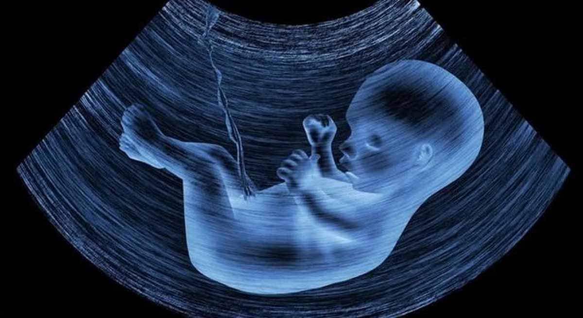 سندروم داون و سقط قانونی؛ مجوز سقط درمانی محدود نشده، فقط رعایت مراحل قانونی شرط اصلی است