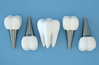 ایمپلنت مشهد