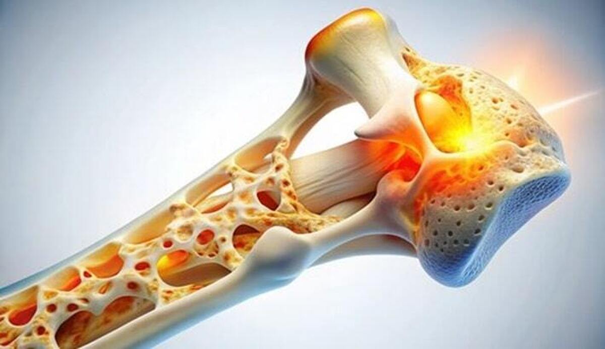 نیمی از زنان بالای ۵۰ سال کشور دچار پوکی استخوان هستند