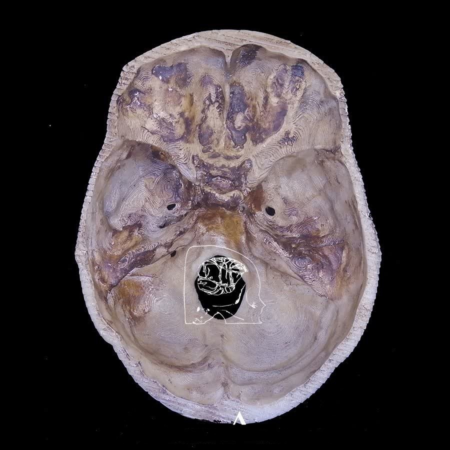 فناوری چاپ سه بعدی در پزشکی؛ از ارتز و پروتزهای سفارشی تا انواع مولاژها +فیلم و عکس فناوری چاپ سه بعدی در پزشکی؛ از ارتز و پروتزهای سفارشی تا انواع مولاژها +فیلم و عکس